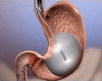 Laparoscopic Single Incision Sleeve Gastrectomy